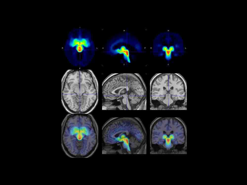 Depression vor den Tagen: Serotonin Transporter im Gehirn erhöht, Max Planck Institut für Kognitionswissenschaften und Neurowissenschaften Depression vor den Tagen: Serotonin Transporter im Gehirn erhöht, Max Planck Institut für Kognitionswissenschaften und Neurowissenschaften
