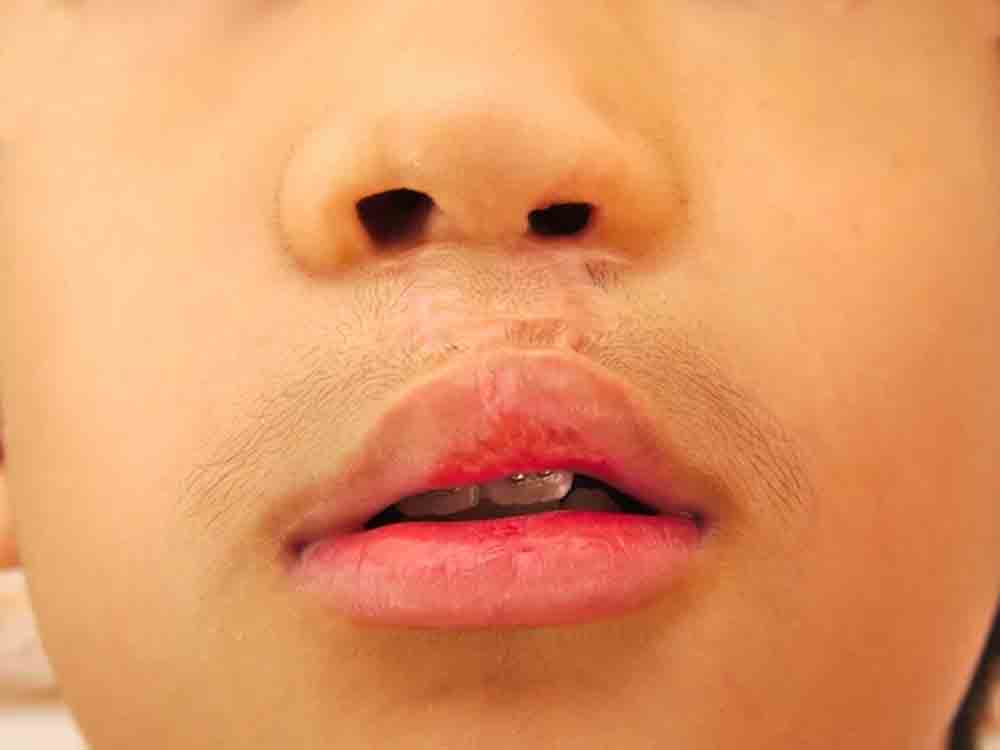 Guinness Weltrekordversuch von Smile Train zum »Cleft Awareness Month«: Dentsply Sirona lädt ein, gemeinsam diese Initiative zu unterstützen Guinness Weltrekordversuch von Smile Train zum »Cleft Awareness Month«: Dentsply Sirona lädt ein, gemeinsam diese Initiative zu unterstützen