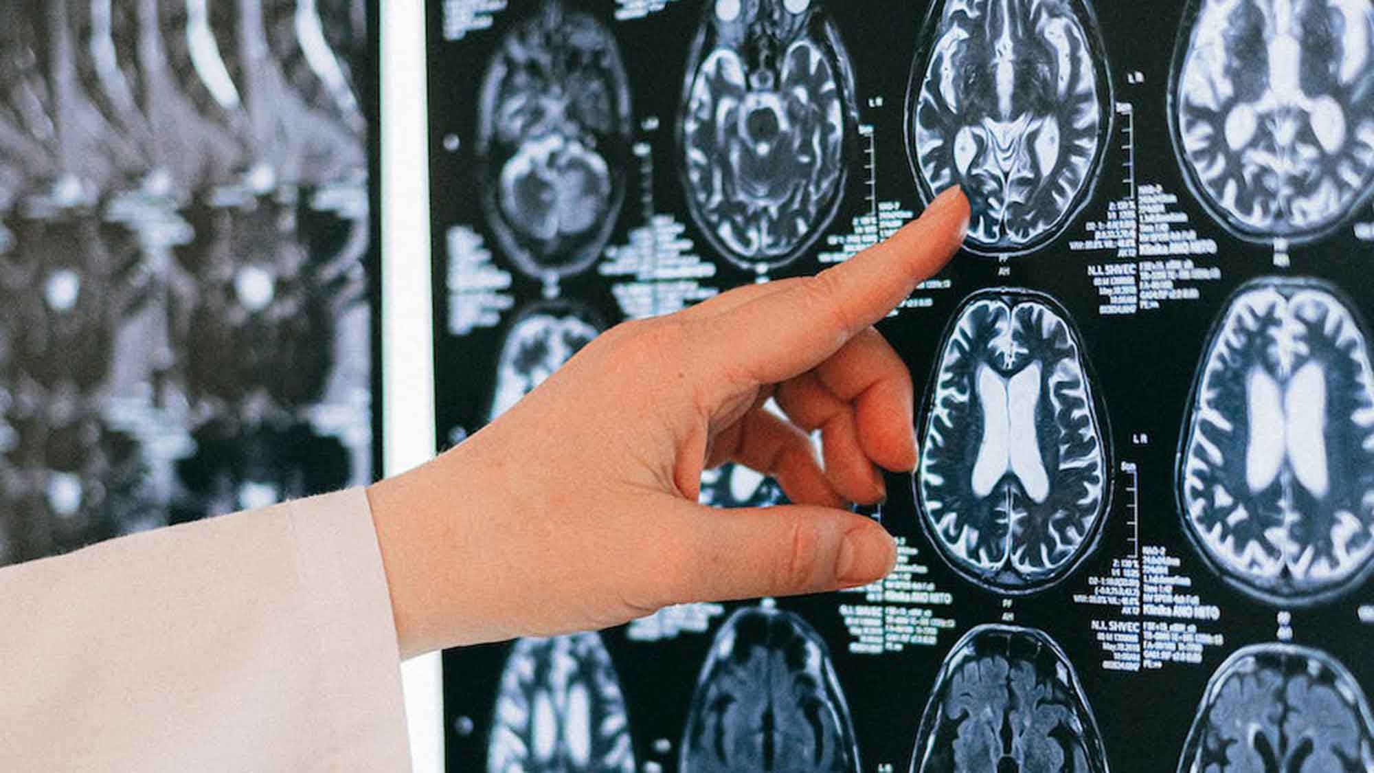 Neue Erkenntnisse zur menschlichen Gehirnentwicklung: Forscher identifizieren geschlechtsspezifische Unterschiede
